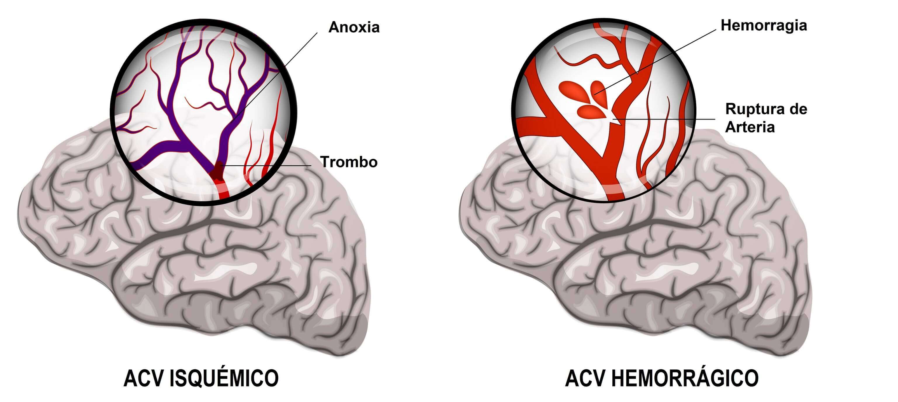ACV isquémico y ACV hemorrágico